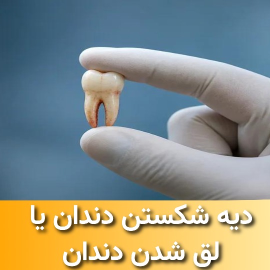 دیه شکستن دندان یا لق شدن دندان