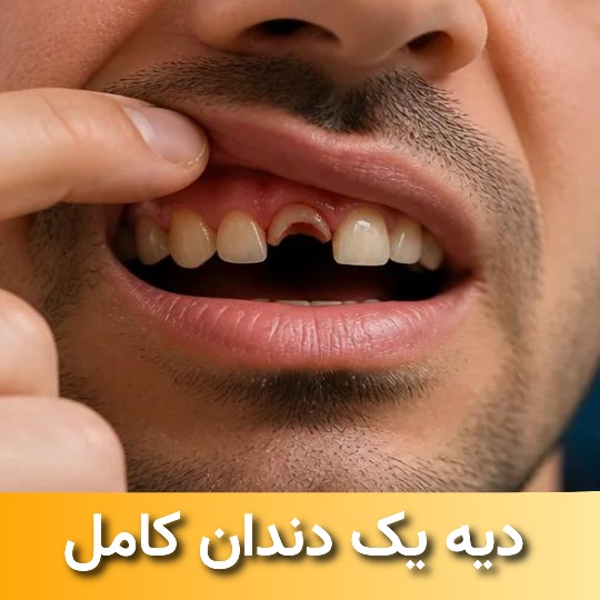 دیه یک دندان کامل از ریشه در آمده چقدر است ؟ 